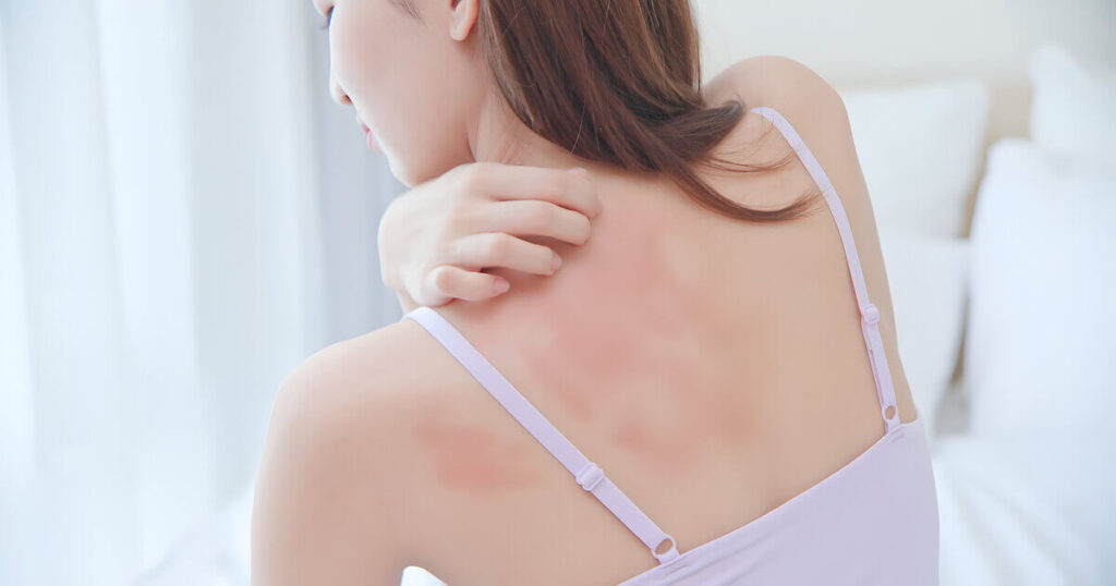 ผิวแพ้ง่ายเกิดจากอะไร